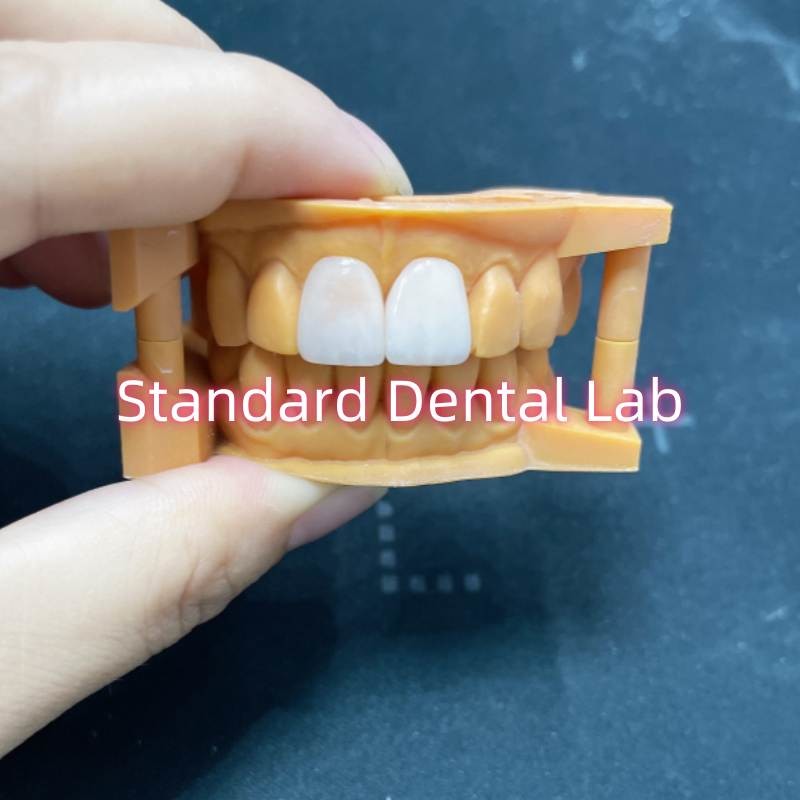 High Colour Stability Ivoclar Emax Laminate Veneers High Translucency