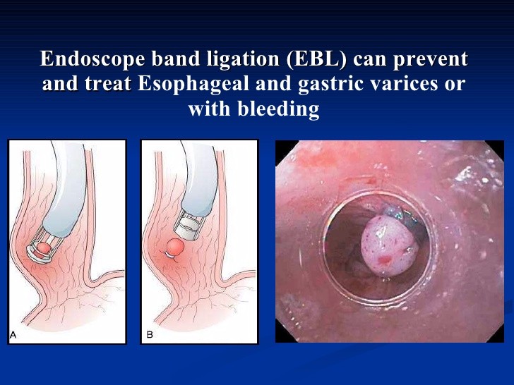 Ligatures endoscopic loop of variceal bands