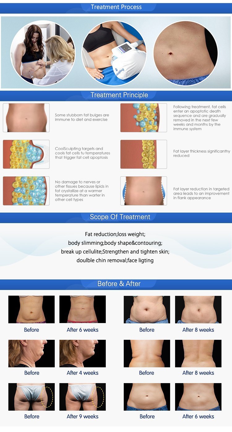 Best triple cooling system RF Vacuum cryotherapy cryolipolysis vacuum cavitation cryolipolysis 4 handles