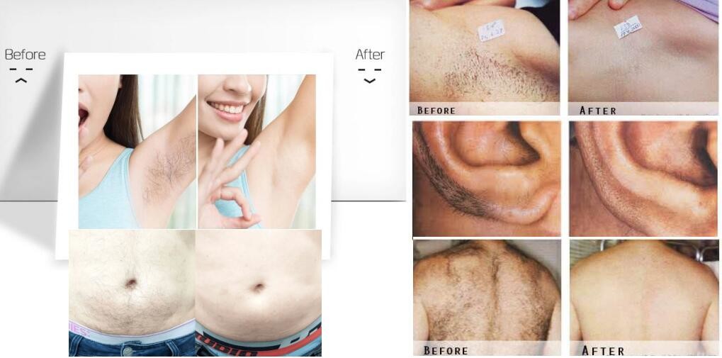 1Hz Beauty Salon Smart 808nm Diode Laser Hair Removal Machine
