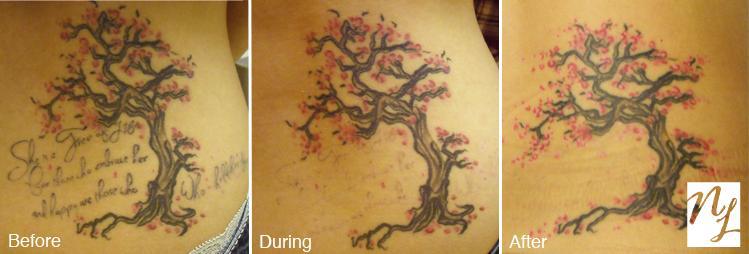Professional q switched nd yag laser tattoo removal machine with CE approved 1064nm/532nm