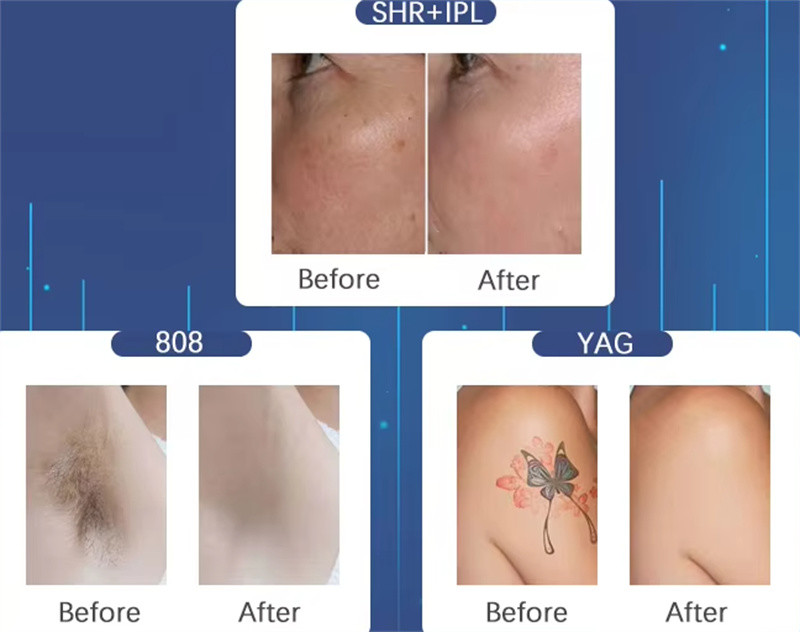 IPL Skin Care+ND Yag Laser Tattoo Removal+Diode Laser Hair Removal for Beauty Center