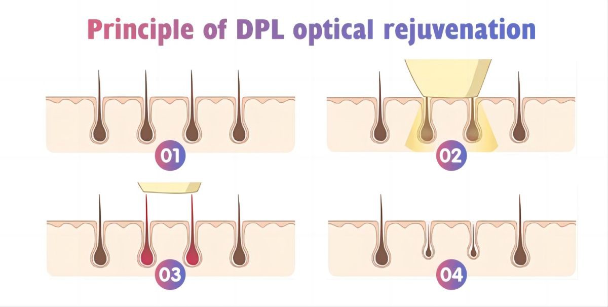 Dpl IPL Laser Hair Removal Equipment Cost High Quality Commercial Use OEM Aesthetics Painless Hair Removal1