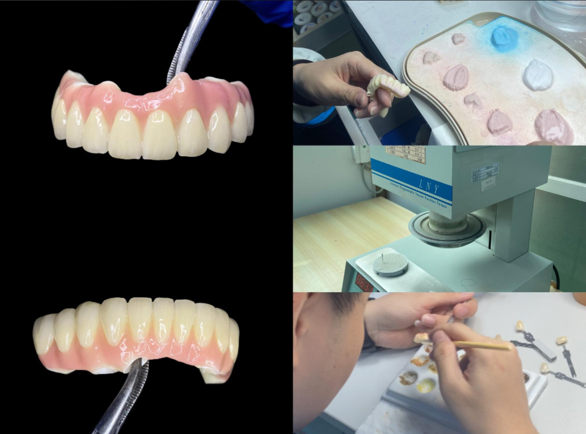 Titanium Dental Implant Crown And Bridge For Tooth Restoration And Replacement