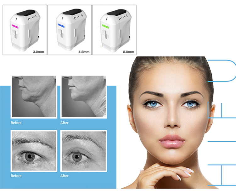 New technology hifu machine three cartridges portable 5D ice HIFU hifu ultrasound