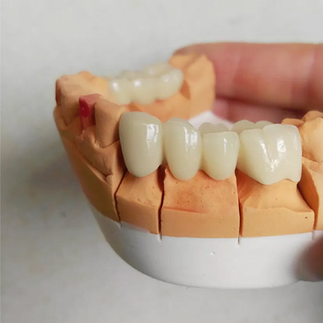 Smooth Surface Removable Partial Dentures PFM Dental Bridge High Quality Assurance