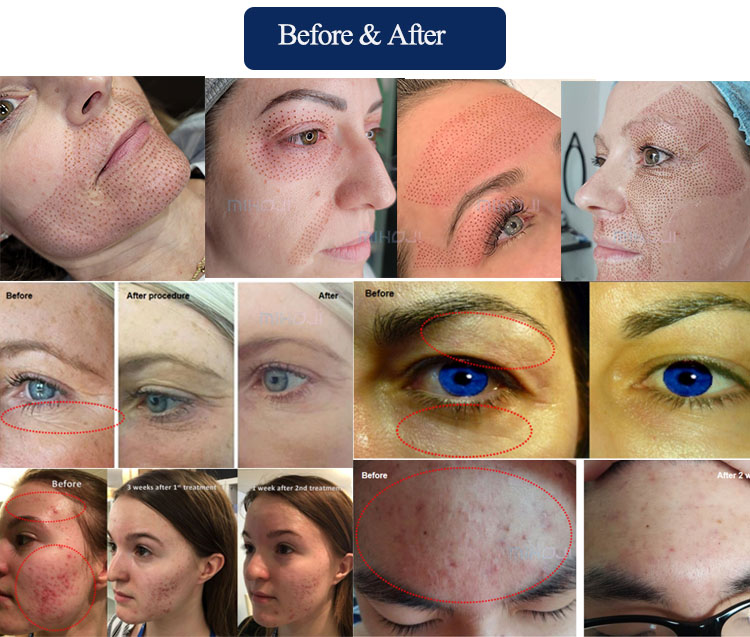 EU Plugs Professional Fibroblast Machine Plasma Pen For Freckle Treatment