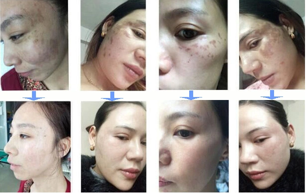 Picosecond Laser Tattoo Removal Device Pico Laser Machine Skin Rejuvenation