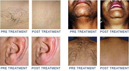 IPL hair removal machine skin rejuvenation machine ipl xenon flash lamp