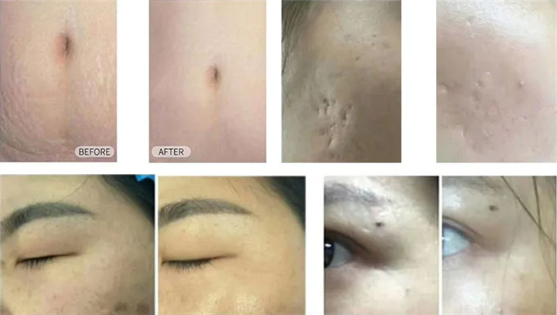 Portable 10600nm Fractional Co2 Laser Machine Scar Acne Removal Beauty