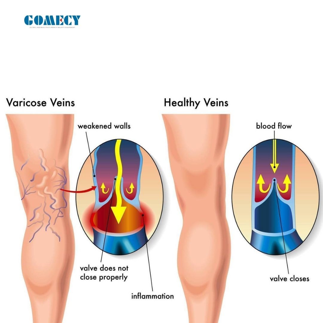 EVLT Varicose Vein Removal Machine Radial Fiber Laser EVLT Endovenous Ablation Treatment Machine