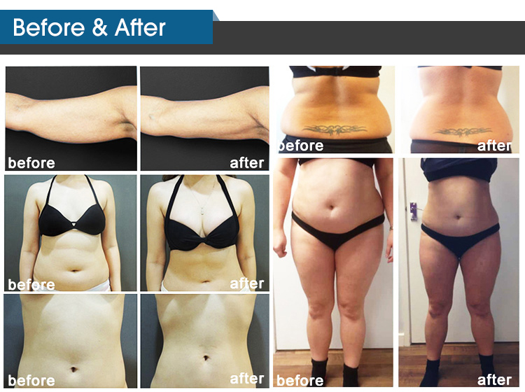 Laser Cellulite Removal Machine , 360 Cryo Fat Freezing Machine