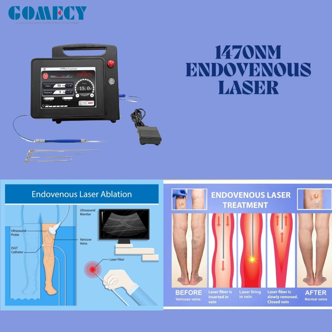 Air Cooling 1470nm Endolift Diode Laser Machine 15w for EVLT, Proctology, PLDD, Veins Reduction