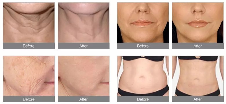 300W 4D High Intensity Focused Ultrasound Facelift Machine