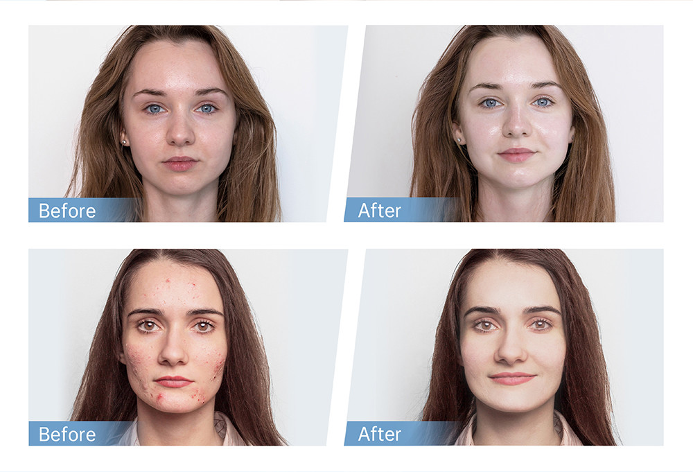 Automated Electric Micro Needle Device For Effortless Skin Rejuvenation