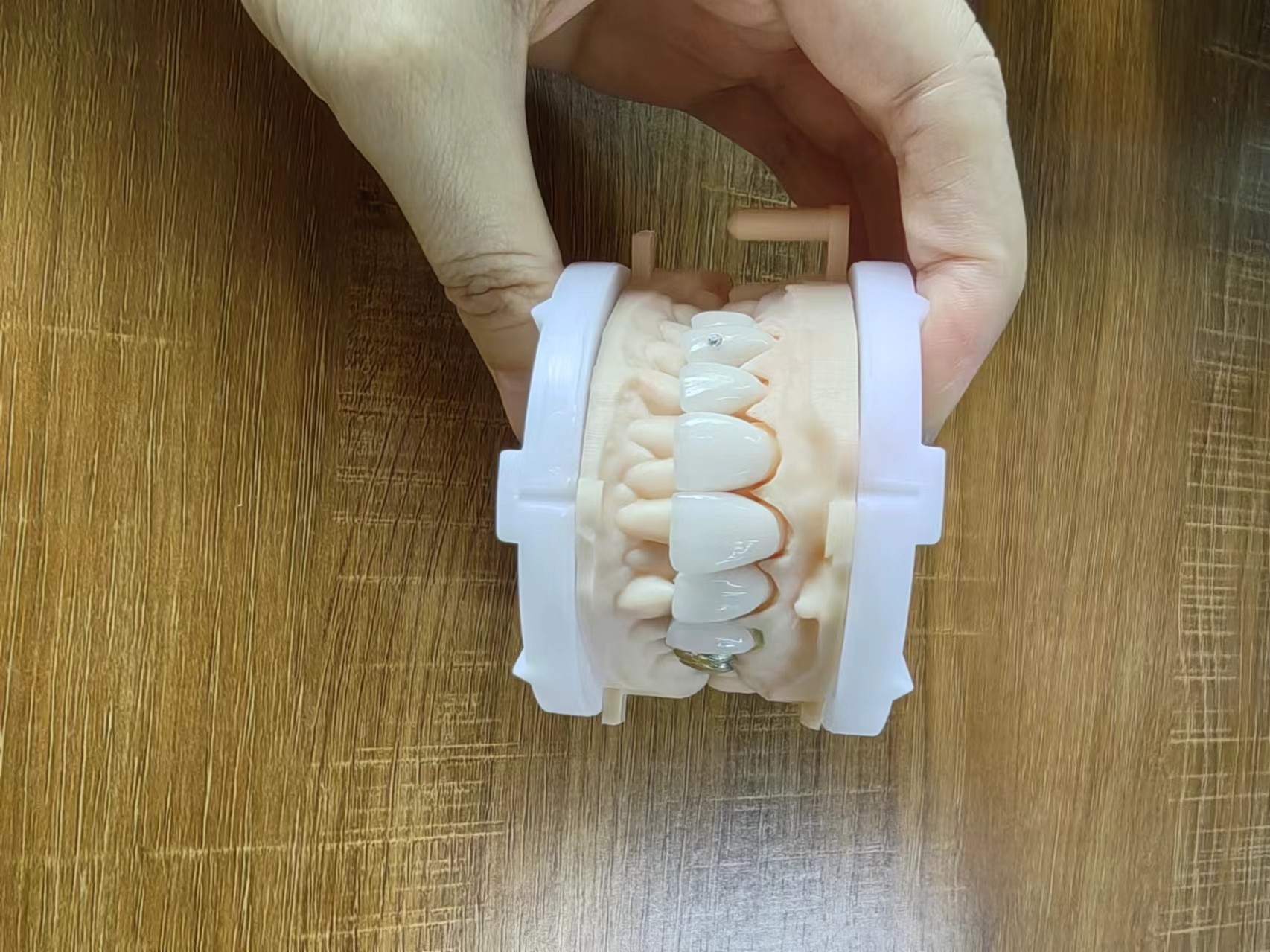 Highly Translucent Zirconia Crowns Bridge Veneers With Customized Jewelry And Gold Beautiful Dental Restoration Case
