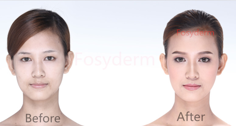 Skin Care Hyaluronic Acid Injectable Dermal Filler for Anti Wrinkle 2ml CE ISO
