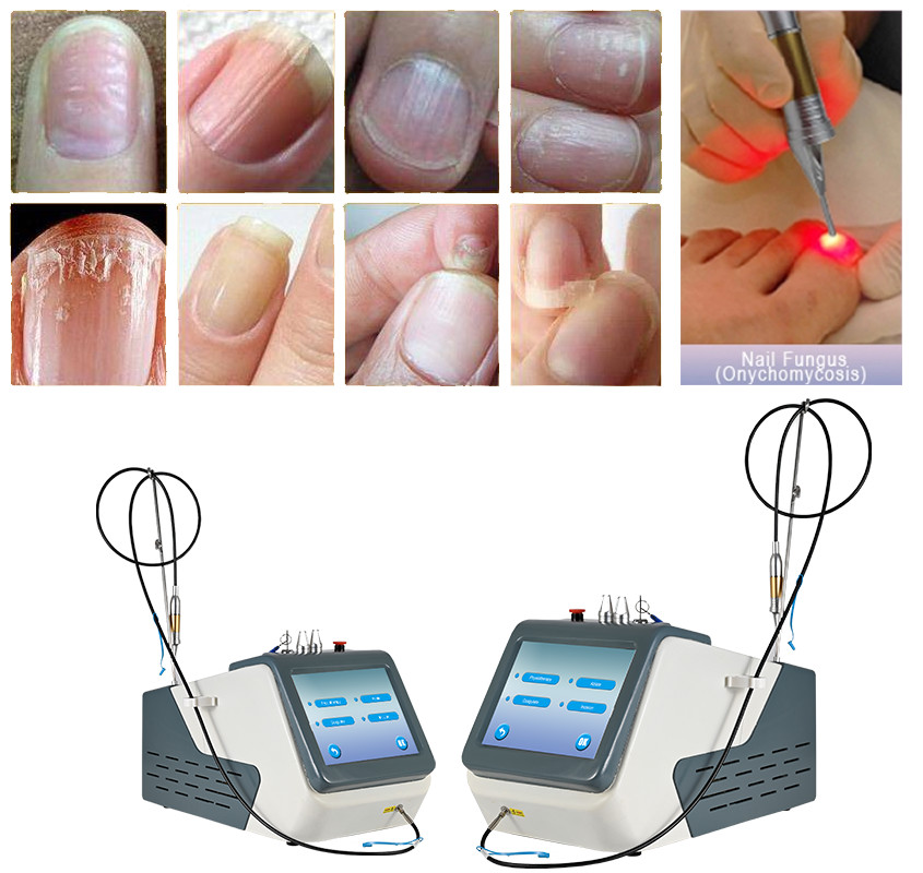 Class IV 980nm Diode Laser For Onychomycosis Therapy