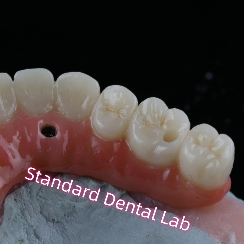Dental Implant Crown PFZ Porcelain Layered Zirconia Screw Retained With Pink Gum