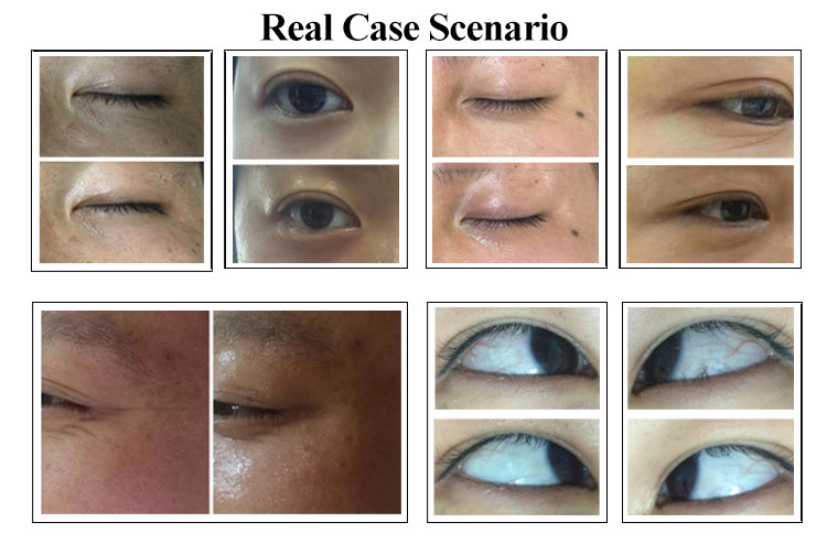 Eye Dark Circles Remove Machine with Vibrator