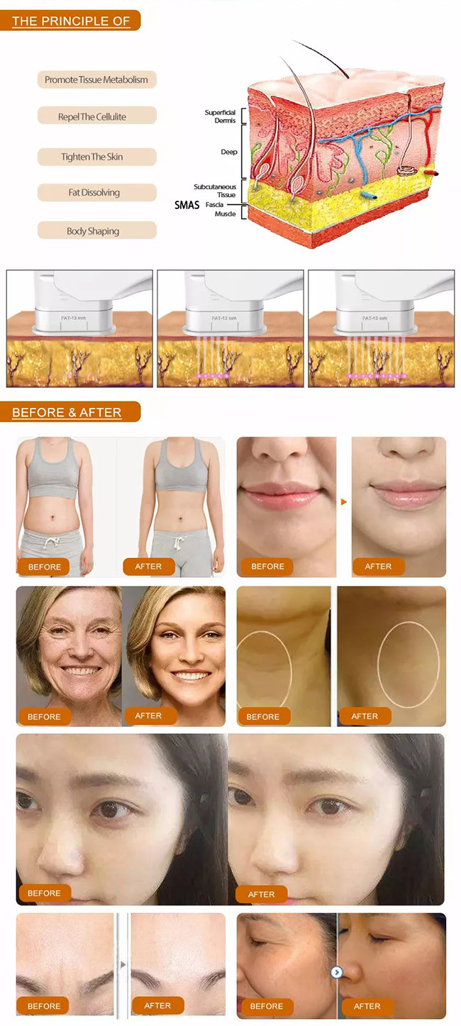 3d 4d 5d 7d 8d Hifu Slimming Machine Face Lifting Anti Wrinkle