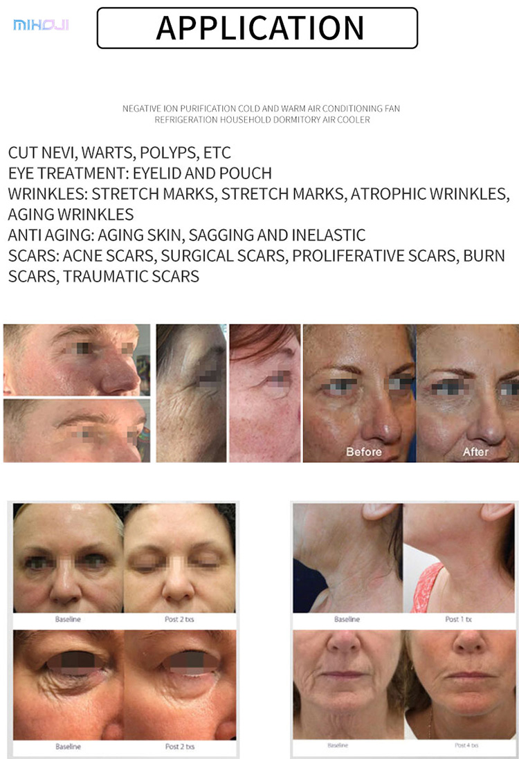 EU Plugs Professional Fibroblast Machine Plasma Pen For Freckle Treatment