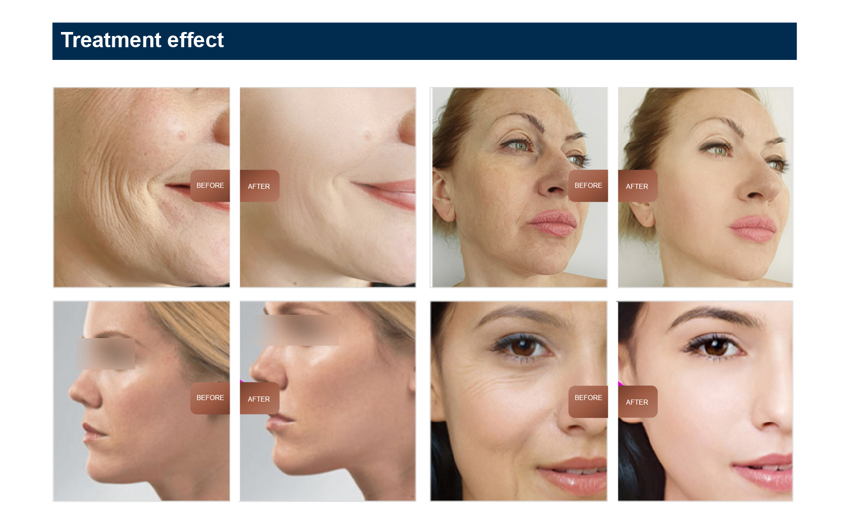 EMS Technology V-face Wrinkle Removal Anti Aging Machine for Portable Facial Firming