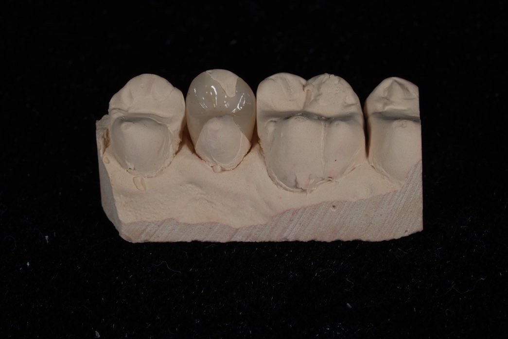 Strength Emax Ceramic Veneers Crown With Excellent Stain Resistance / Biocompatibility