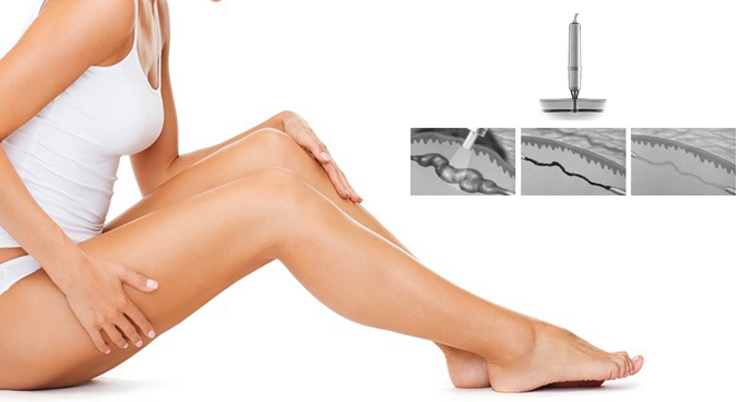 Excellent results multi spot high power diode 980nm laser vein removal