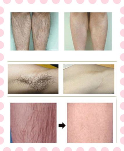 Professional 808nm Diode Laser Hair Removal Machine With 12 Laser Bar