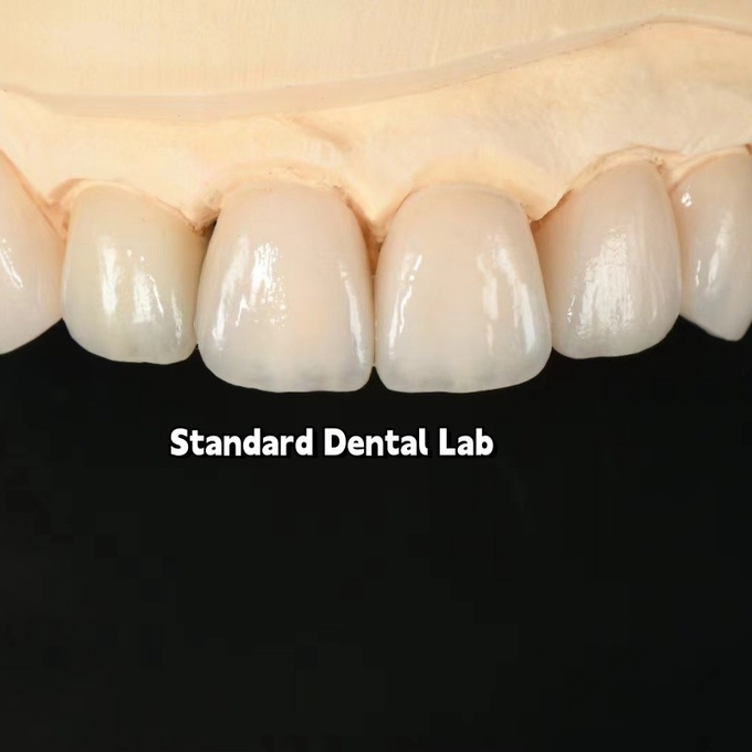 High Quality dental implant crown/bridge Zirconia Crown and All On Four Six Implant Full Arch|China dental lab 15