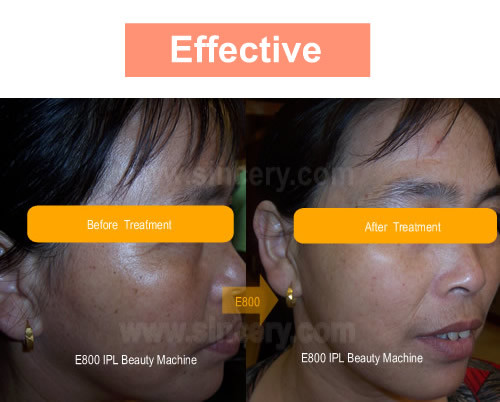 Painless IPL Laser Hair Removal Machine For Full Body / Face Skin Lightening