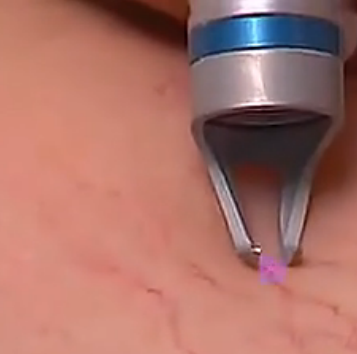 portable Diode 980nm laser for vascular removal machine