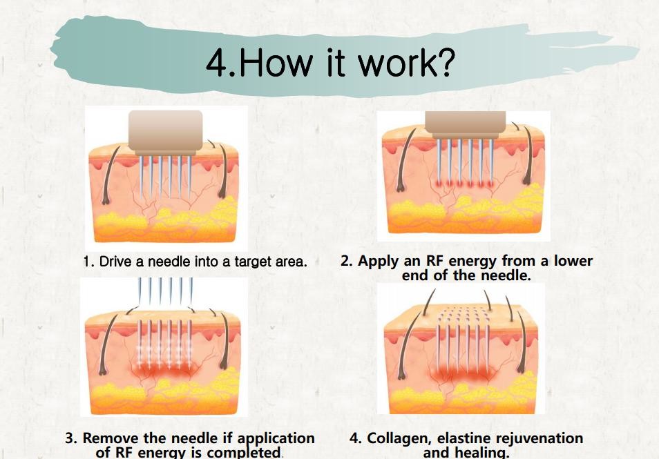 Skin maintenance microneedle nurse system Fractional radiofrequency micro needling
