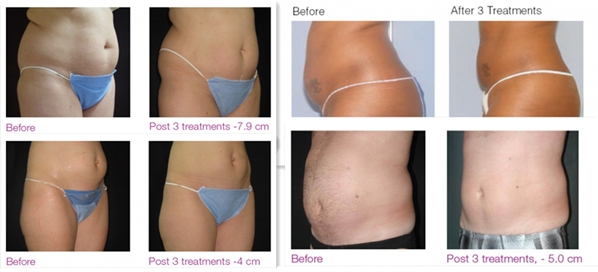 Newest technology CE approval high quality hot selling hifu body slimming machine