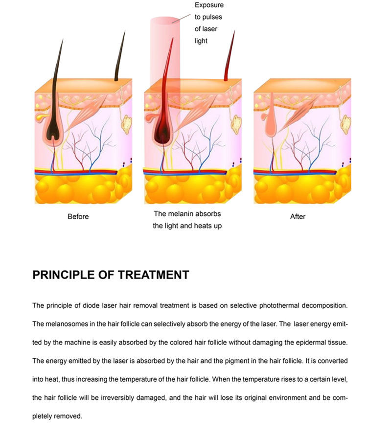 Permanent Diode Laser Hair Removal Machine For Home CE