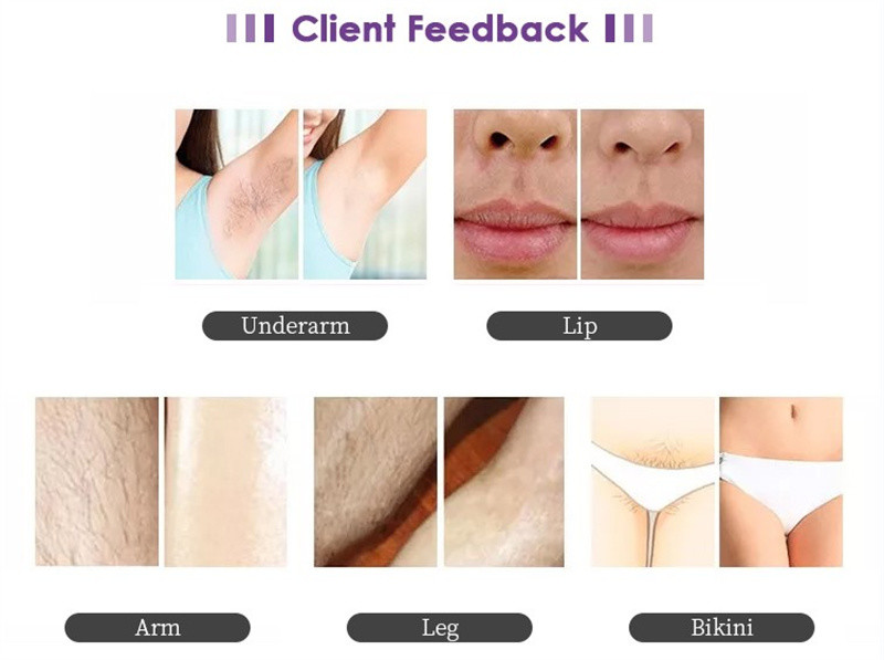 808 Nm Yag Laser Diode Hair Removal Machine 500w 1600w For Face And Body