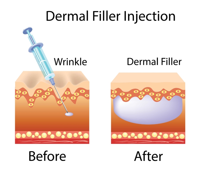 Lip Function Dermal Lip Fillers 1ml For OEM Natural Looking Plumping Lip Fillers