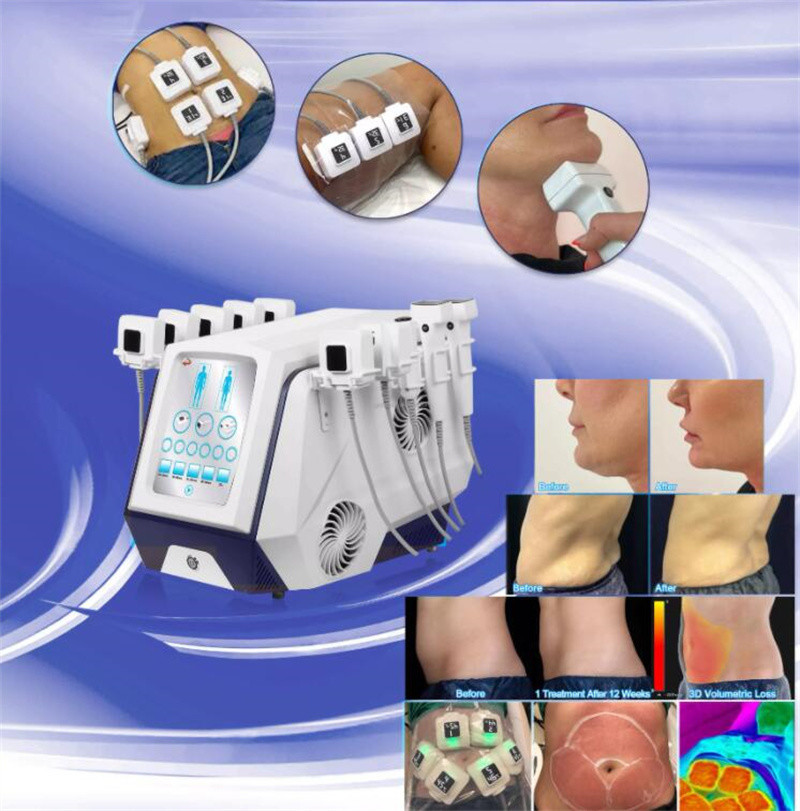 Monopolar Rf Beauty Equipment Trusculpt 3d Body Slimming Fat Reduce 5MHz