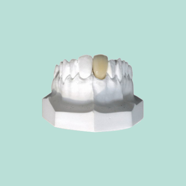 Customized Porcelain Crowns Have A Real Appearance And Natural Color