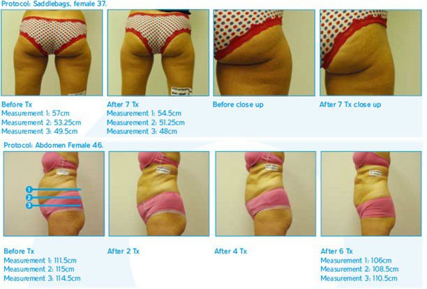 High quality Portable Cryolipolysis+Lipo Laser Slimming Machine for sale