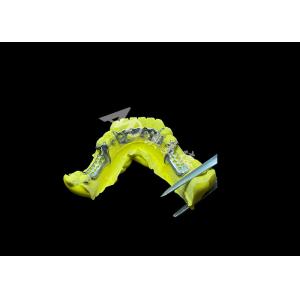 Tailored Cast Partial Denture with Personalized Aesthetics and Secure Fit for Enhanced Comfort and Functionality