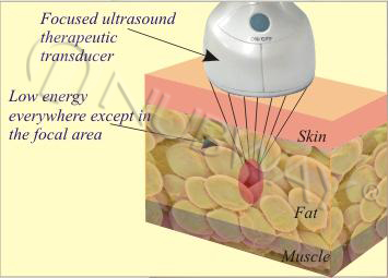 Manufactory supply newest HIFU slimming machine for sale