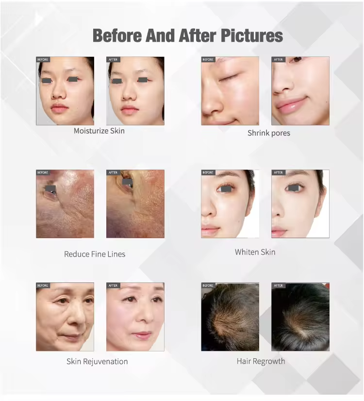 EMS RF Mesotherapy Machine Portable Mesotherapy No Needle Machine Microdermabrasion