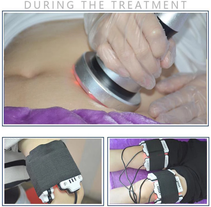 RF Fat Freeze Slimming Machine 360 Skin Tightening Cryolipolysis Equipment