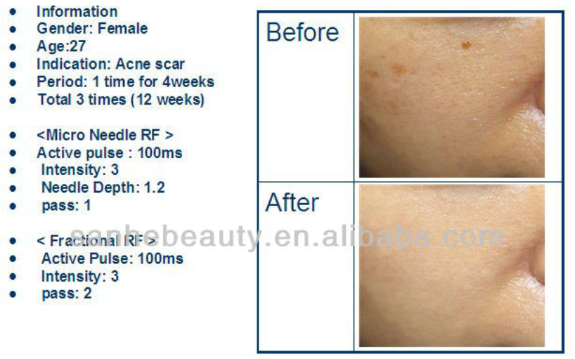 Micro Needle RF Fractional Skin Resurfacing Machine , Acne Scar Removal Machine