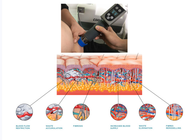 2 In 1 Cryolipolysis Slimming Machine , Portable Cryolipolysis Machine