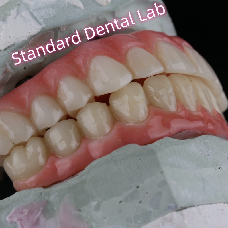 Dental Implant Crown PFZ Porcelain Layered Zirconia Screw Retained With Pink Gum