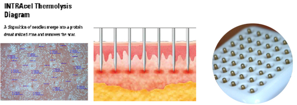 Best price Fractional Rf Wrinkle Removal Face Lift, Skin Rejuvenation, Wrinkle Remover, ScMicroneedle quipment for sale