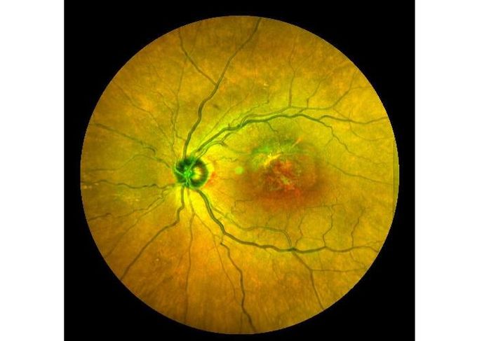 Ultra-wide Field Laser Scanning Retina Angiograph Digital Ophthalmic Equipment With Optical Zoom 100°/60°/30°